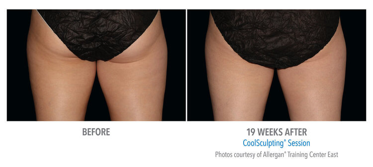 cool sculpting before and after, New Image Cosmetics, Edmonton AB