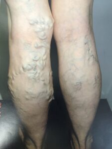 Leg Vein Therapy, new image cosmetic, edmonton AB