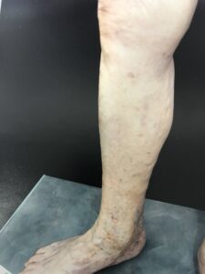 leg vein therapy, new image cosmetic, edmonton AB