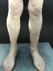 leg vein therapy, new image cosmetic, edmonton AB