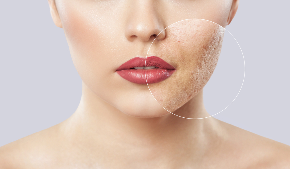 The Art of Renewal: Exploring the Benefits of Laser Skin Resurfacing | New Image Cosmetic